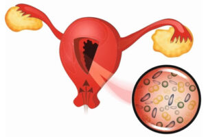 эндометрит