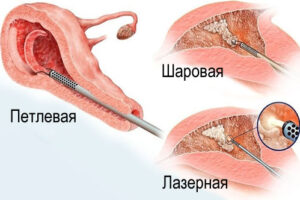 лечение эндометрита