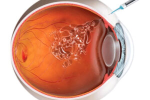 лечение панофтальмита