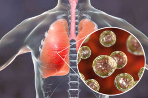 бластомикоз