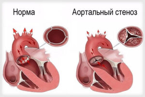 аортальный стеноз