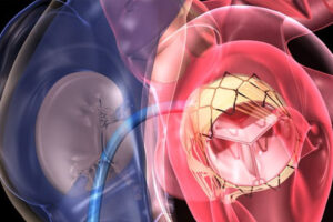 лечение аортального стеноза