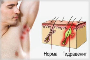 гидраденит