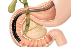 лечение холангита