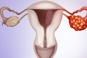 фиброма яичников