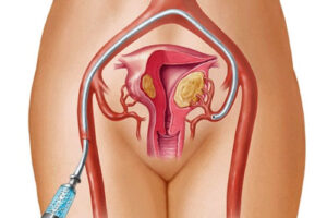 лечение фибромы яичников