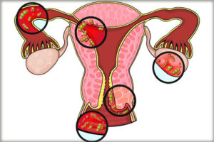 вестибулит