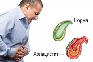 холецистит