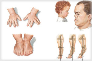 ахондроплазия