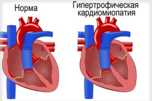 гипертрофическая кардиомиопатия