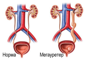 мегауретер
