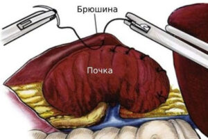 лечение нефроптоза