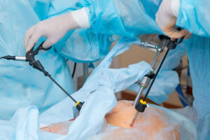 лечение ишемии мезентериальных сосудов