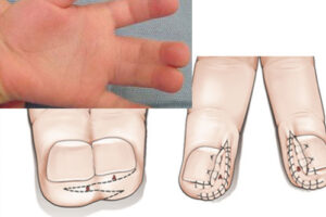 синдактилия