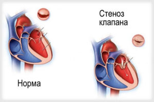 митральный стеноз