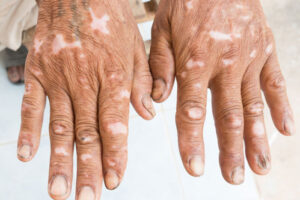 склеродермия