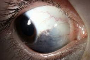 алкаптонурия