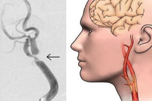 стеноз сонной артерии