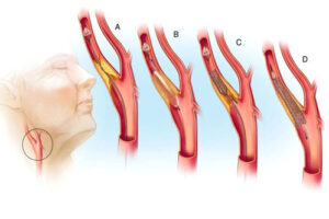лечение стеноза сонной артерии