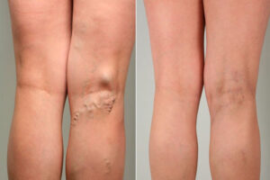 лечение тромбофлебита