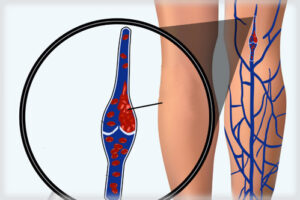 тромбофлебит