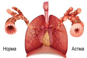 бронхиальная астма