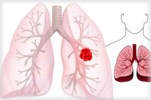 аденома бронхов