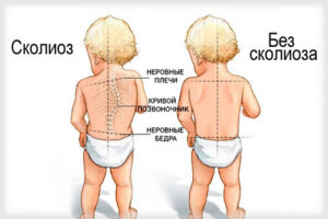 детский сколиоз