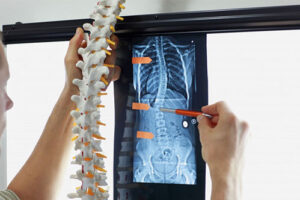 лечение детский сколиоза