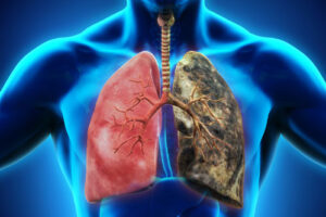 гангрена легкого