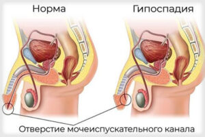гипоспадия
