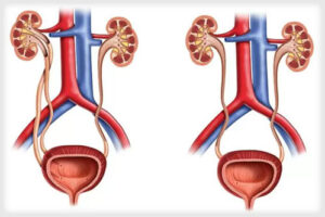 эктопия мочеточника