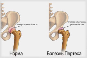 болезнь Пертеса