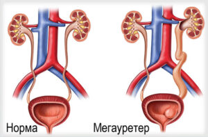 мегауретер