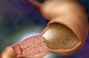 пилоростеноз