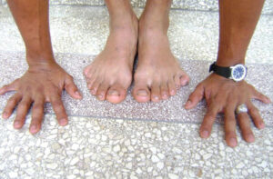 полидактилия