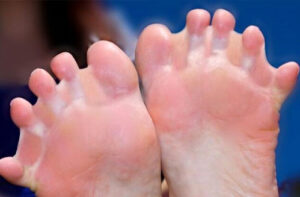 синдактилия