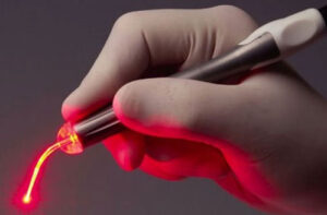 лечение синдактилии