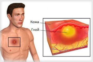 актиномикоз