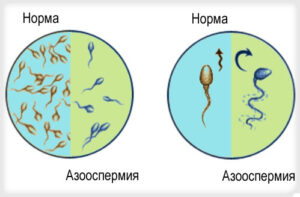 азооспермия