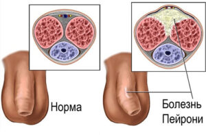 болезнь Пейрони