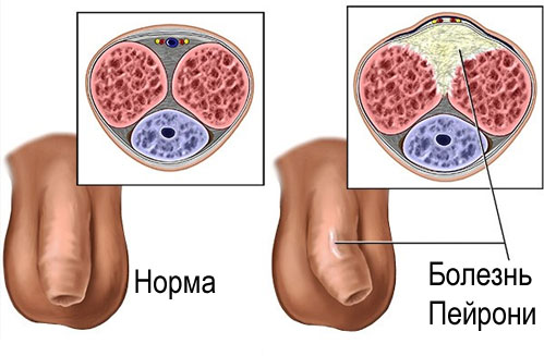 Увеличение полового члена клиника