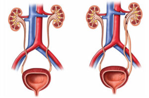 уретероцеле