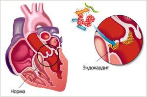 эндокардит