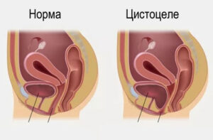 цистоцеле