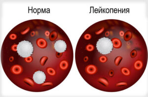 лейкопения