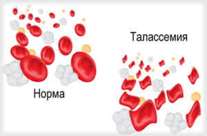 талассемия