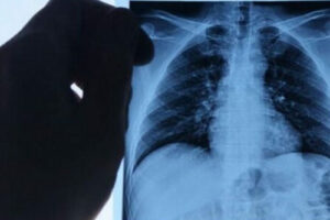 эхинококкоз