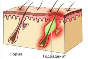 гидраденит