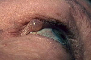 гидроцистома